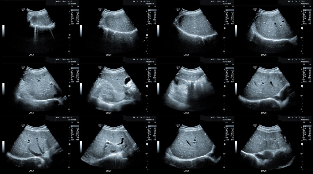Abdominal ultrasound image of a healthy, unremarkable,  human liver.  The hepatic parenchyma is homogeneous.  (The liver tissue is healthy.) This image is tinted a blueish grey.
