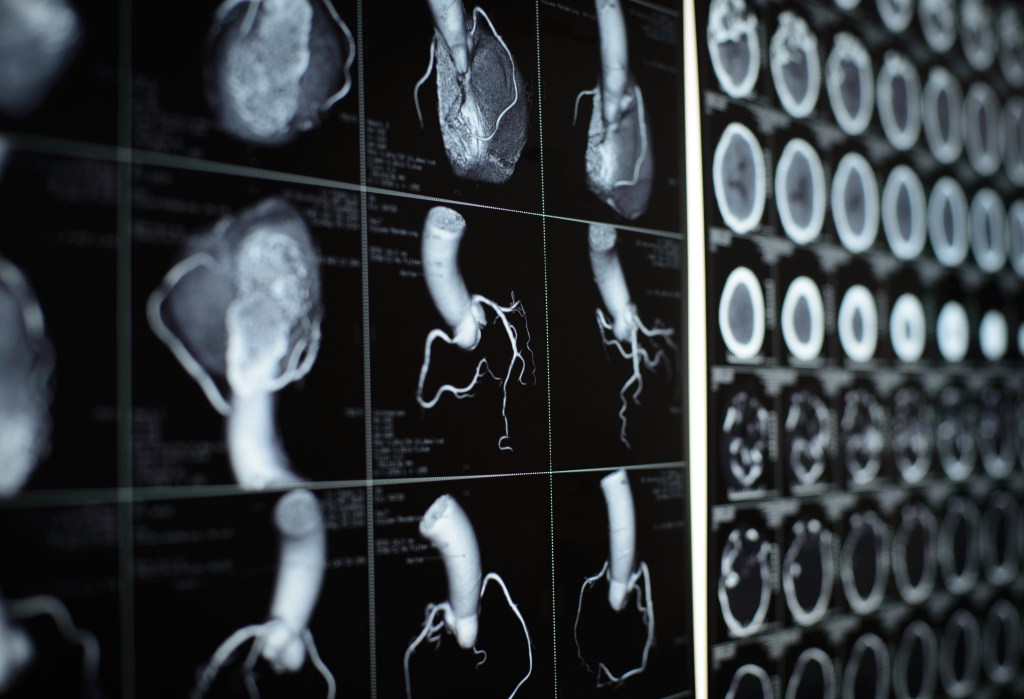 human heart and coronary artery  CT images on black film.